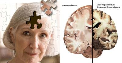Ученые знают, как увидеть болезнь Альцгеймера за 6 лет до ее начала