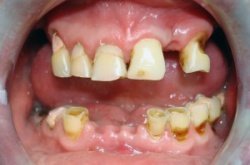 Потеря зубов говорит о повышении риска смерти