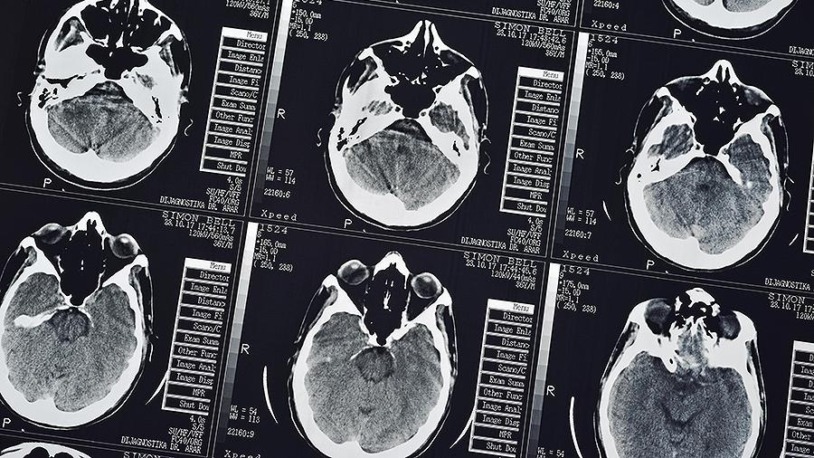 Ученые «взломали» механизм старения мозга