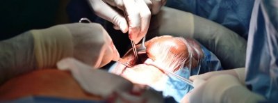 Австралийские врачи успешно пересадили мертвое донорское сердце