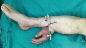 Китайские врачи спасли руку пациента, пришив ее к ноге - Похоронный портал