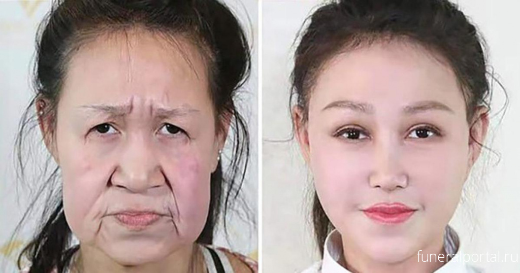 15-летней девочке, выглядевшей на 60, хирурги сделали новое лицо