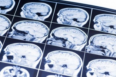 Ученые разработали новый метод диагностики черепно-мозговой травмы
