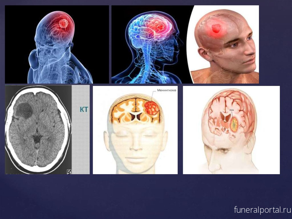 Онкологи перечислили симптомы рака головы и шеи