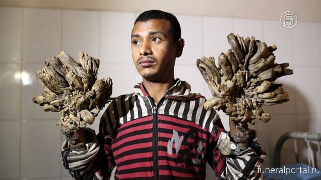 «Человек-дерево» из Бангладеш просит врачей ампутировать ему руки