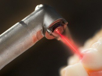 Лазер помог вырастить ткани зуба из стволовых клеток