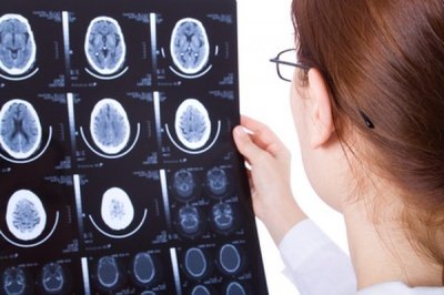 Человеческий мозг способен компенсировать вред от болезни Альцгеймера